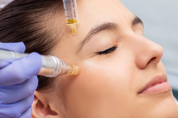 What are the pros & cons of microneedling?
