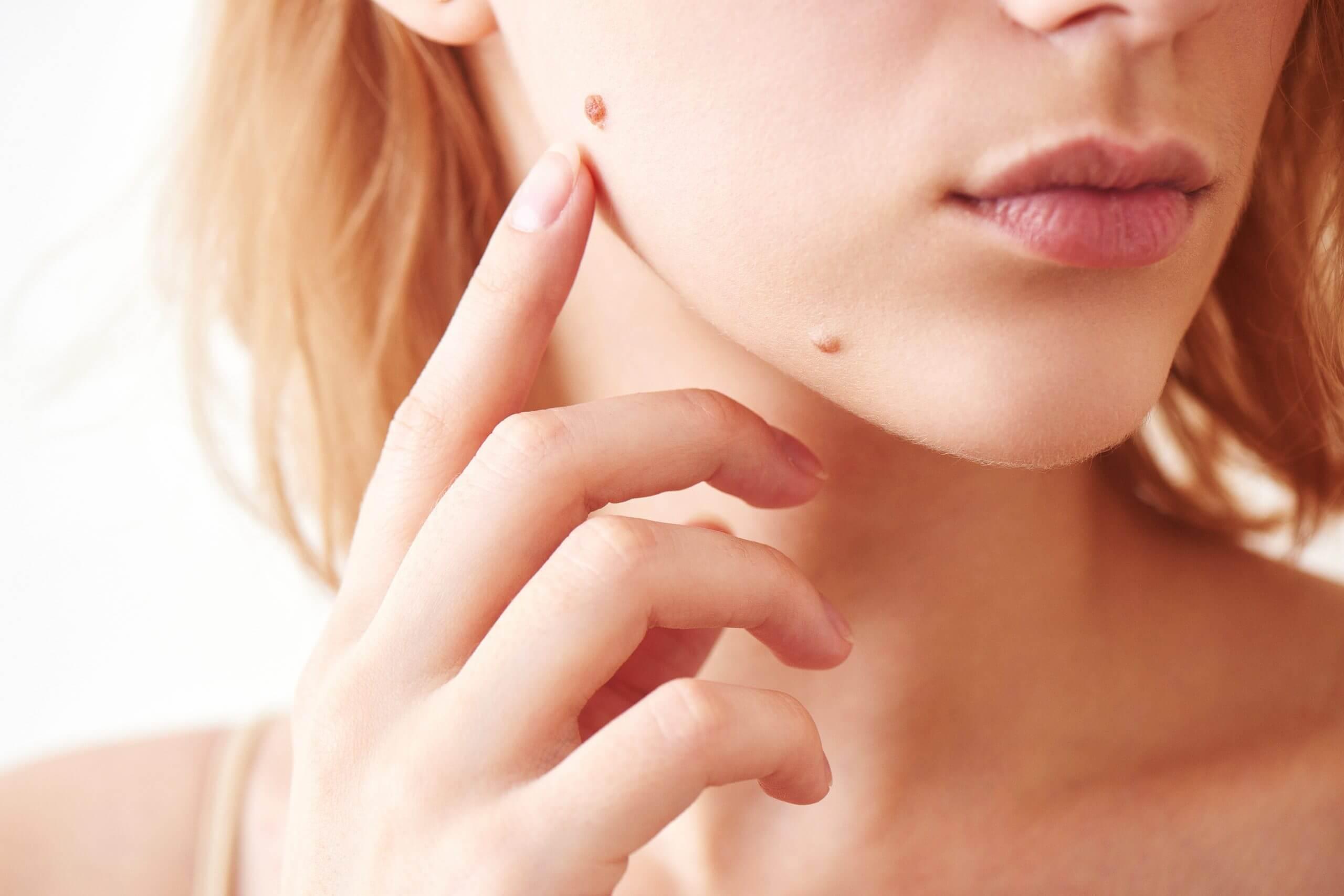 Who needs to have mole removal treatment? 