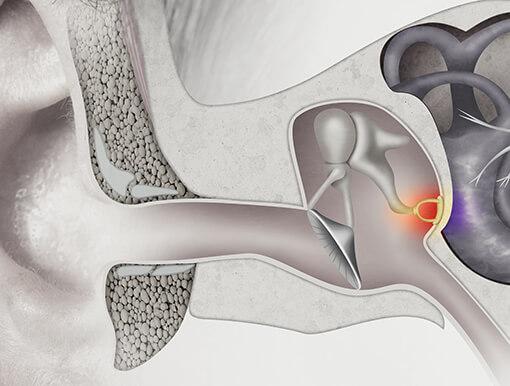 Stapedectomy recovery & long-term care