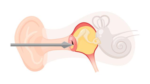 Benefits & risks of Myringotomy