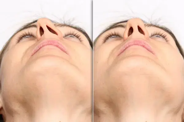 What are the potential benefits and risks of septoplasty?