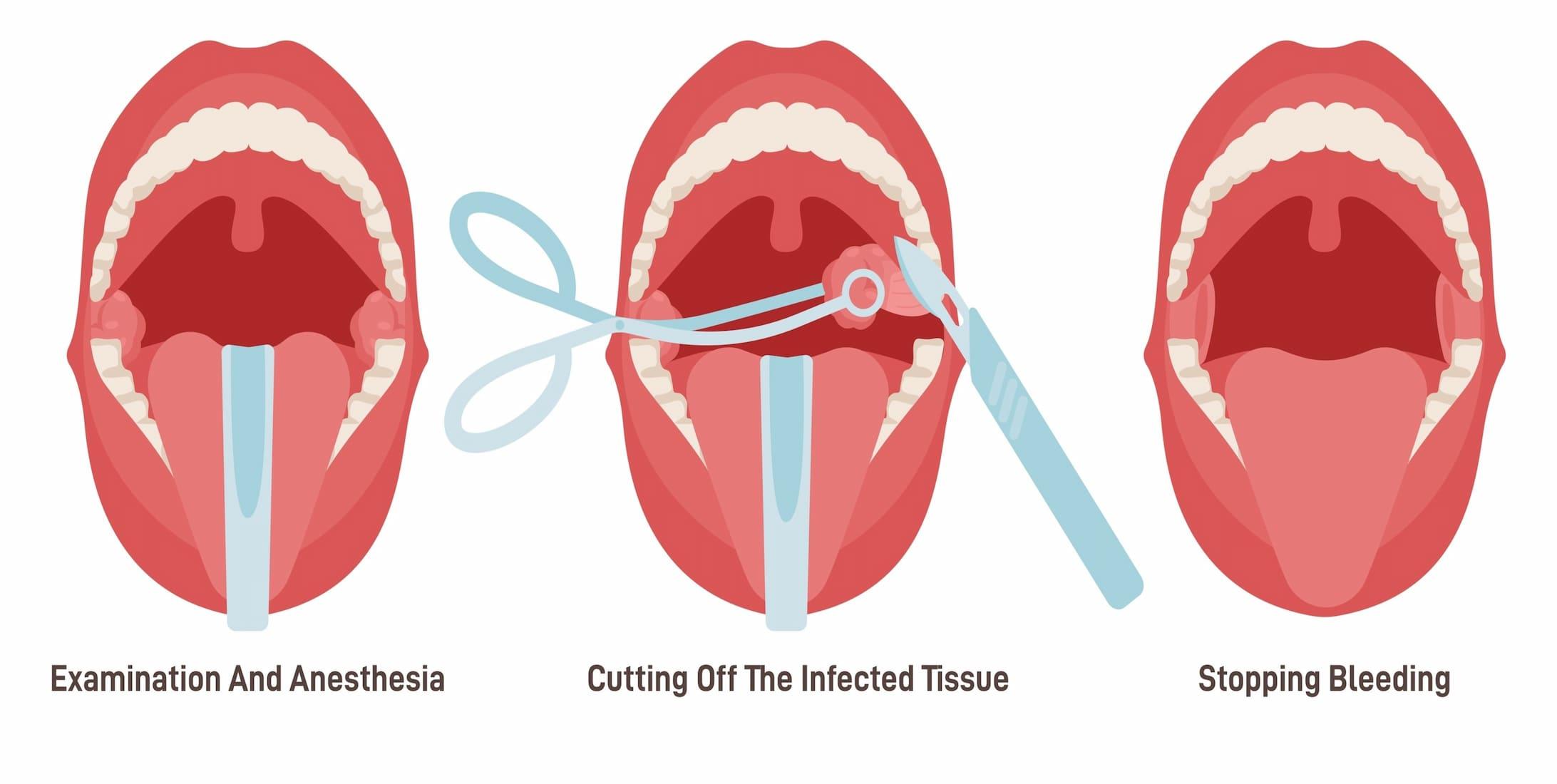 How is a Tonsillectomy done?