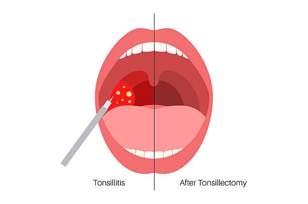 What can I eat after a tonsillectomy?