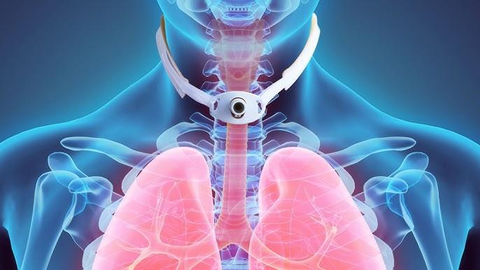 What is a laryngectomy?