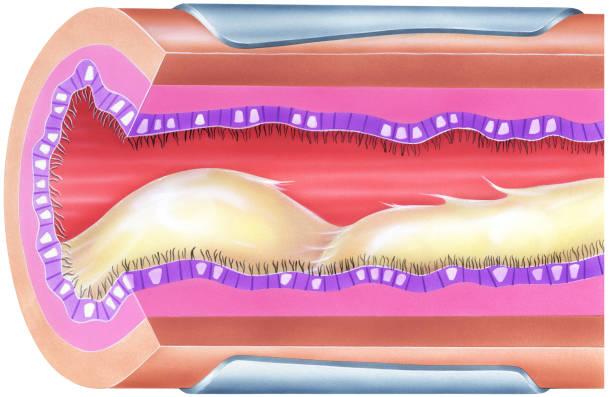 How can I prevent chronic bronchitis?