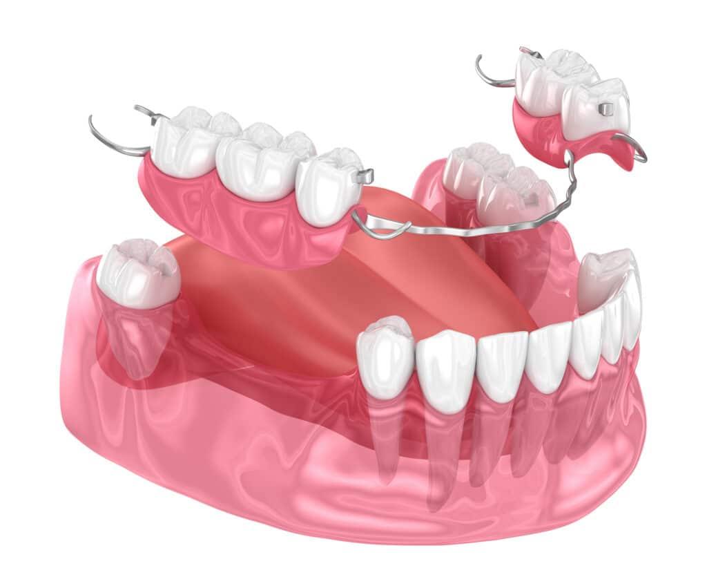 What are the different types of dentures?