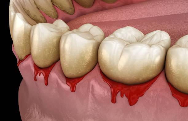 Periodontal disease stages