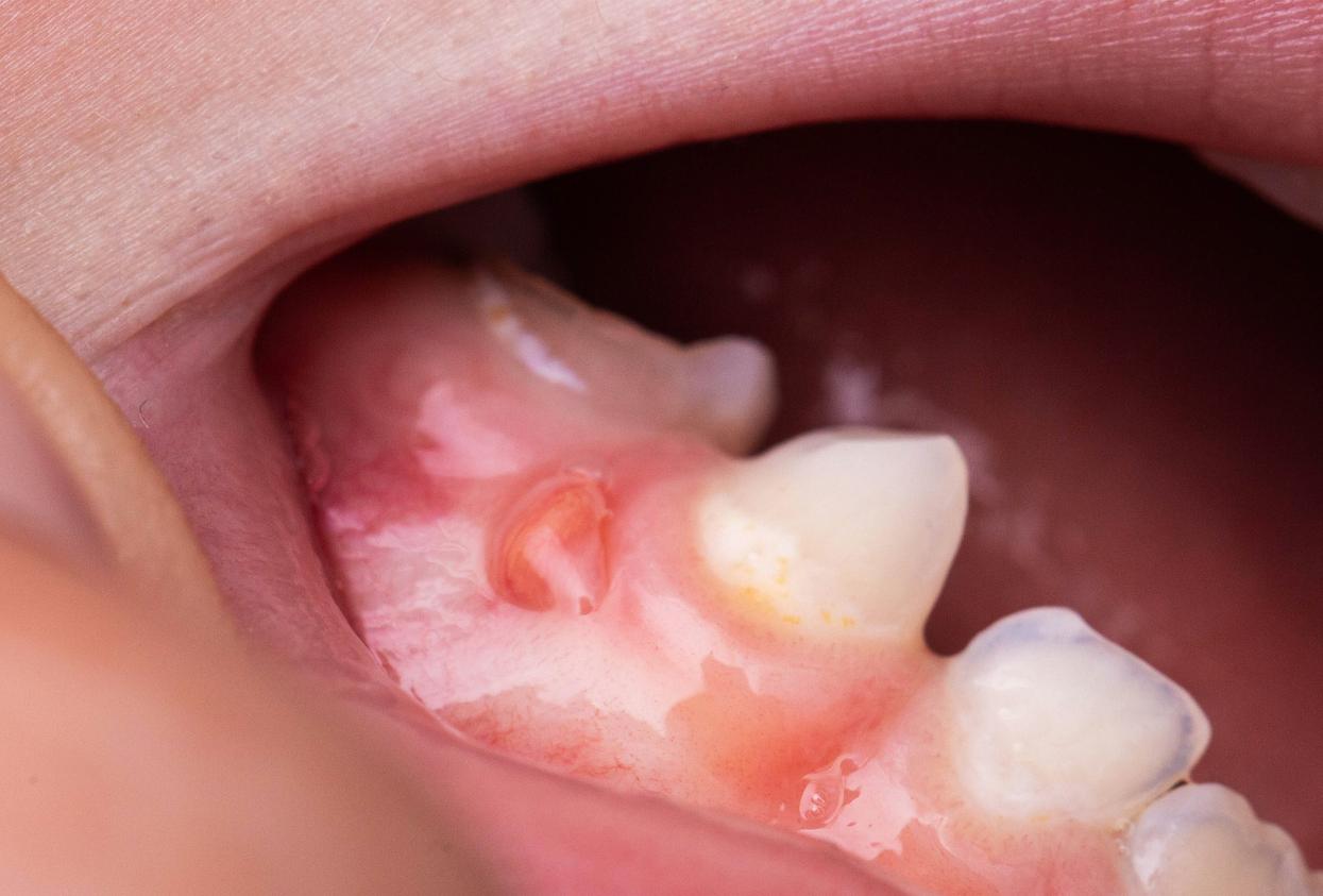 Treatments for Gum Disease