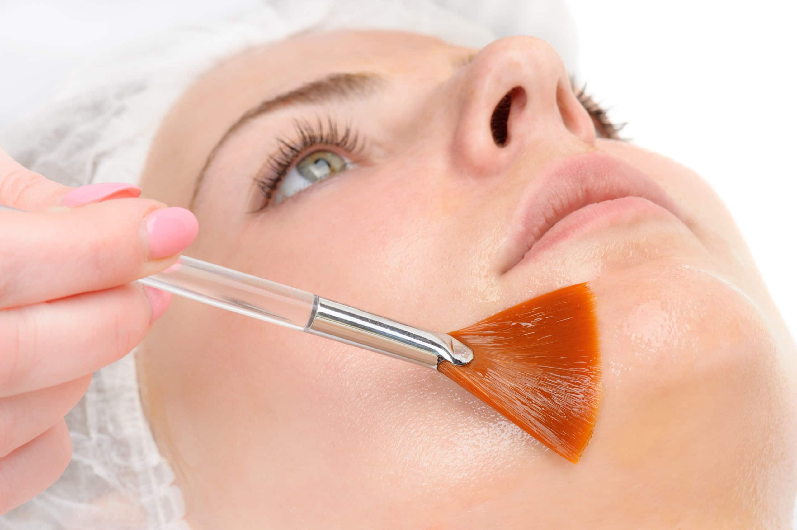 What is a chemical peel?