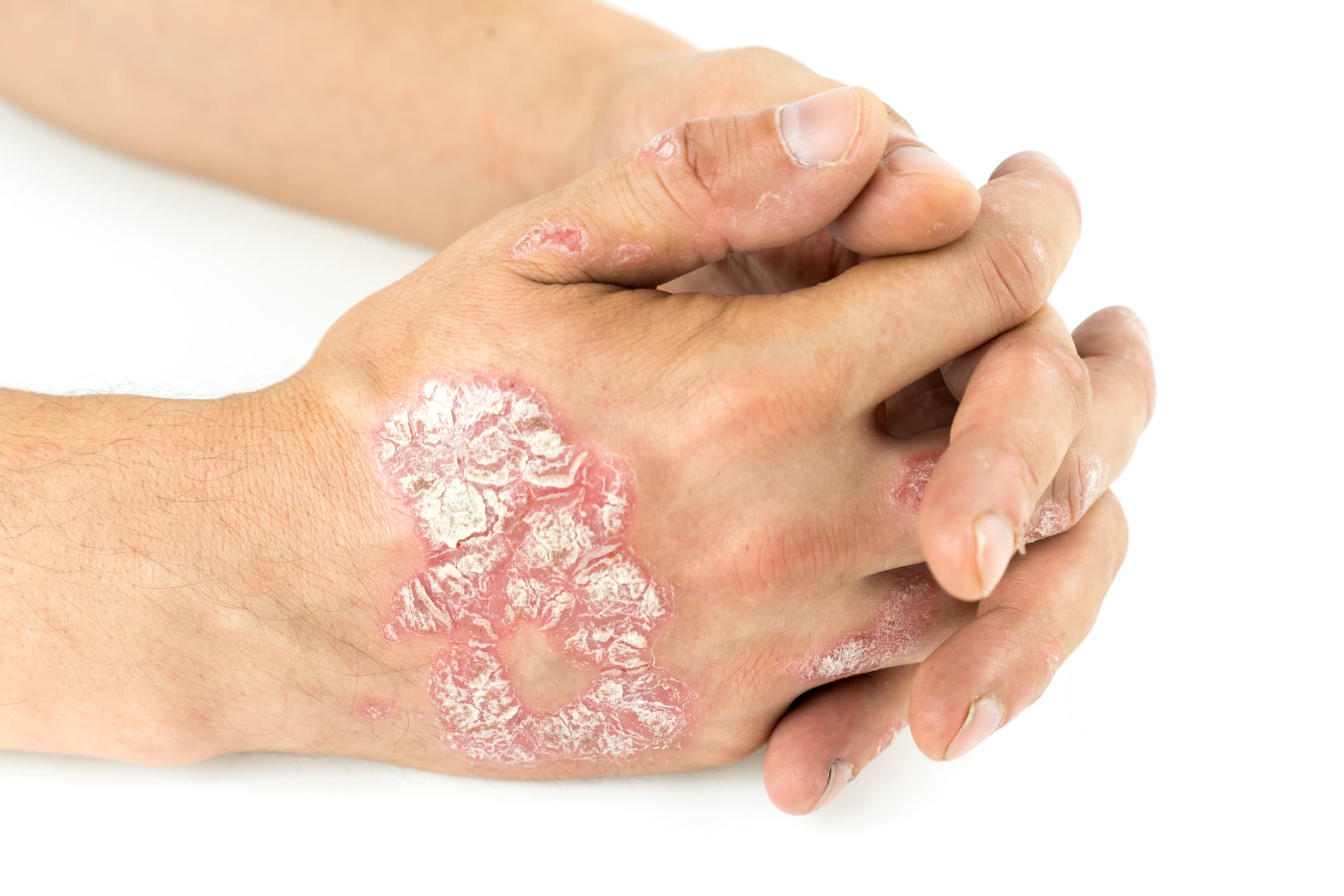 What is psoriasis?