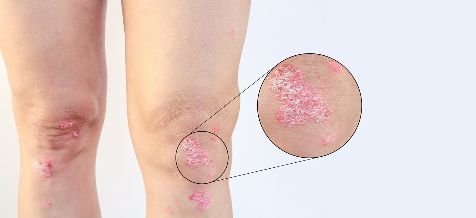 What part of my body will psoriasis affect?