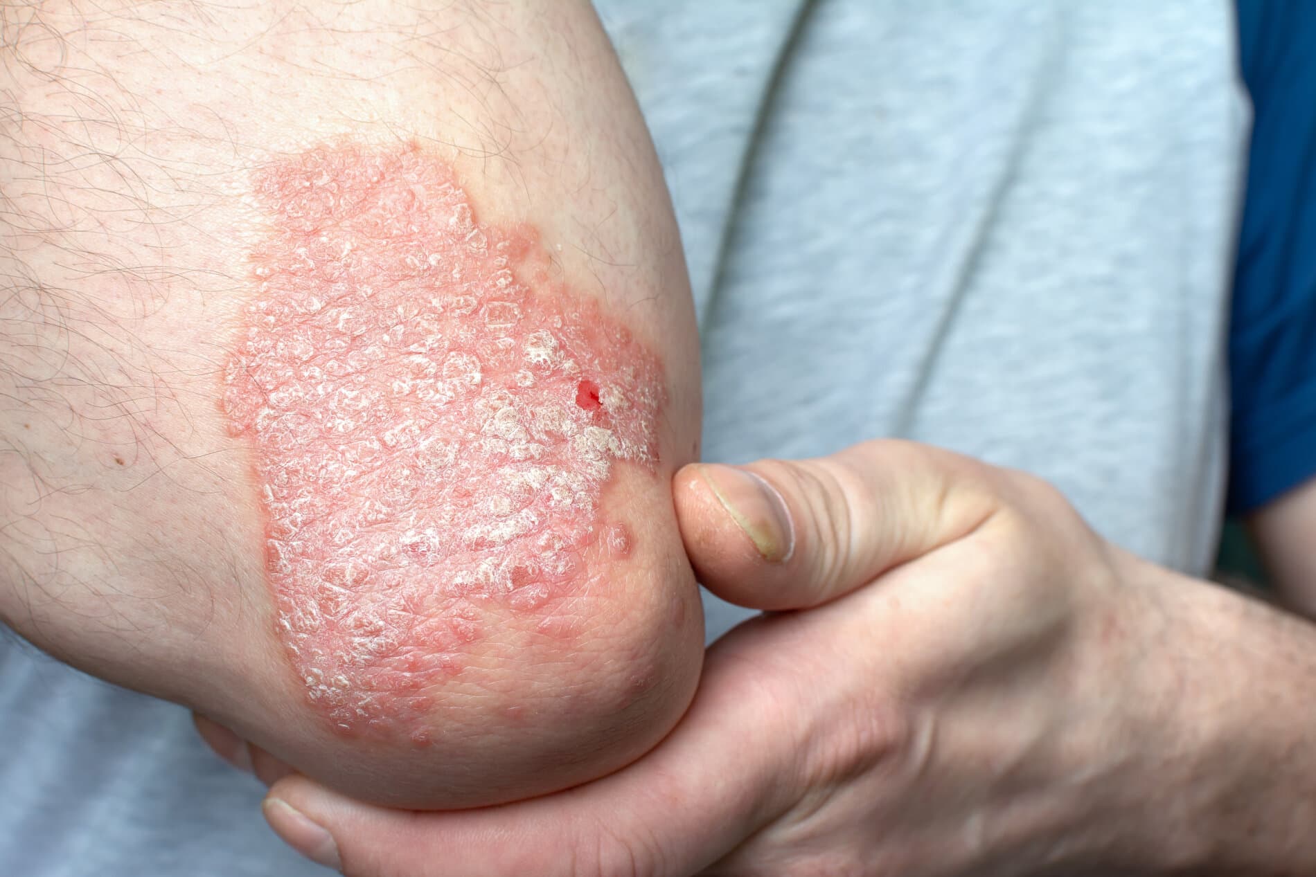 What are the symptoms & causes of psoriasis?