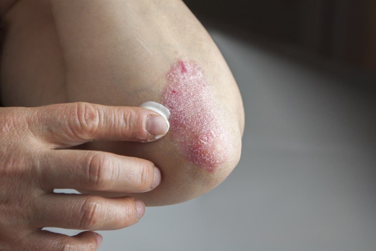 What are psoriasis invasive treatment options?