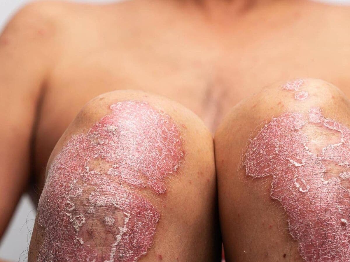 Can psoriasis be permanently cured?