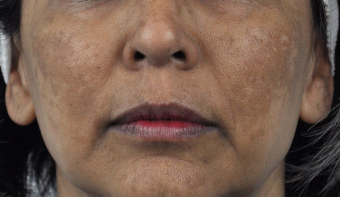 What is melasma?
