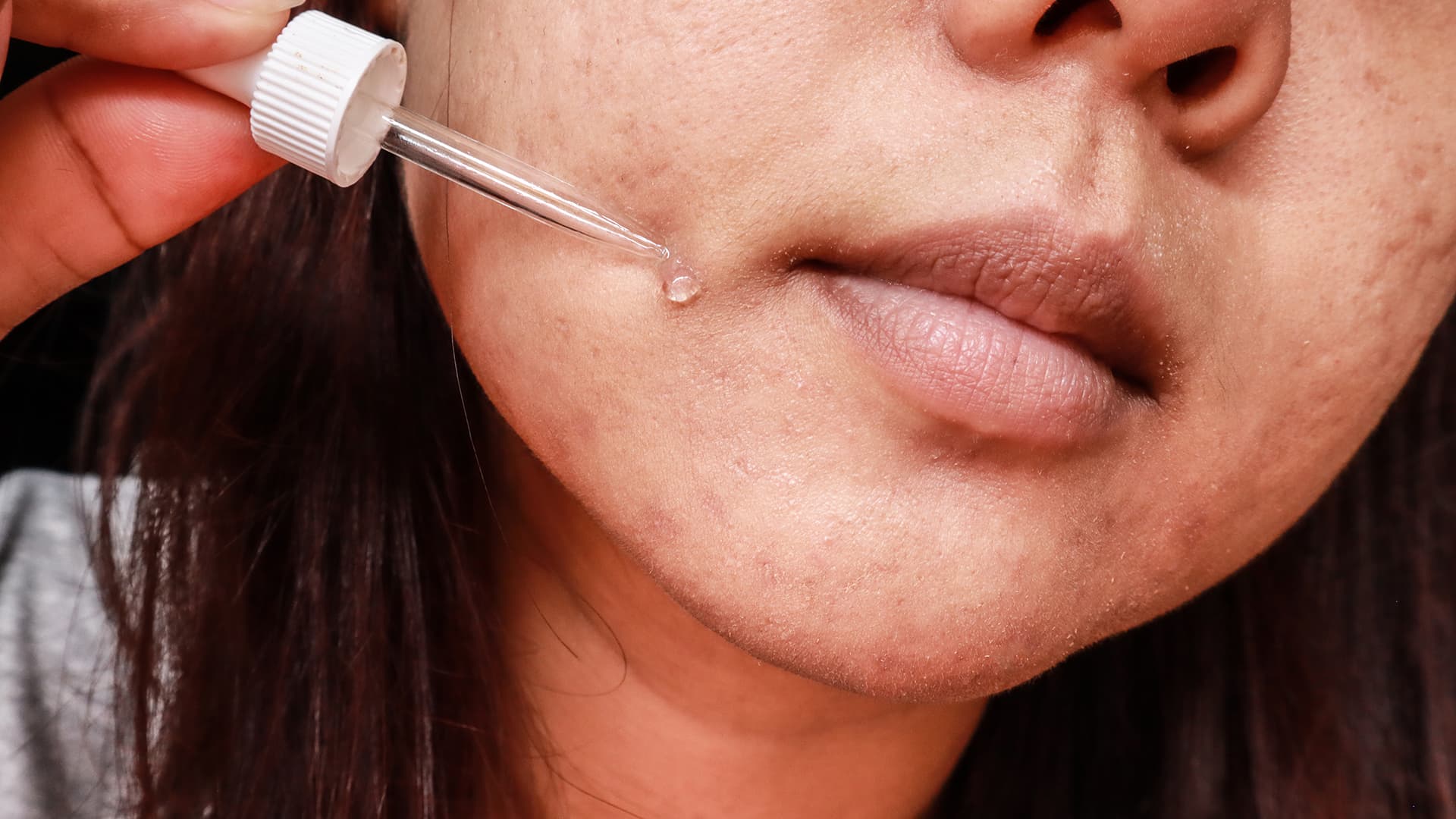 What are the types of melasma?