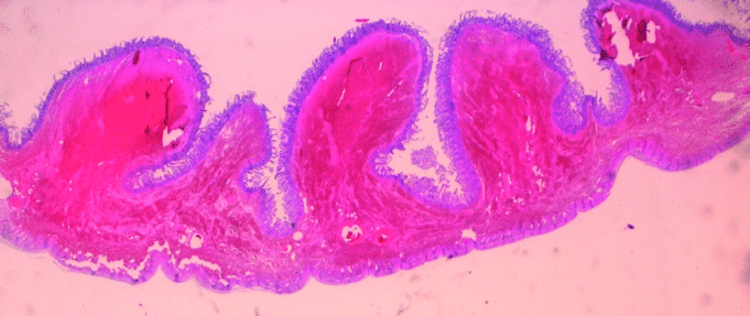 What is Coagulative Necrosis?