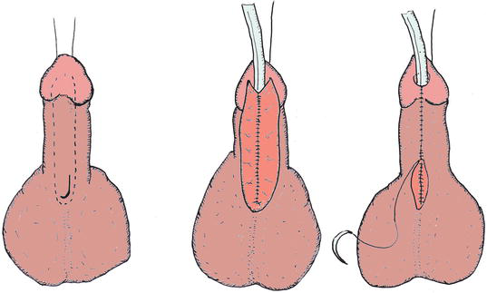 What are the symptoms of hypospadias?