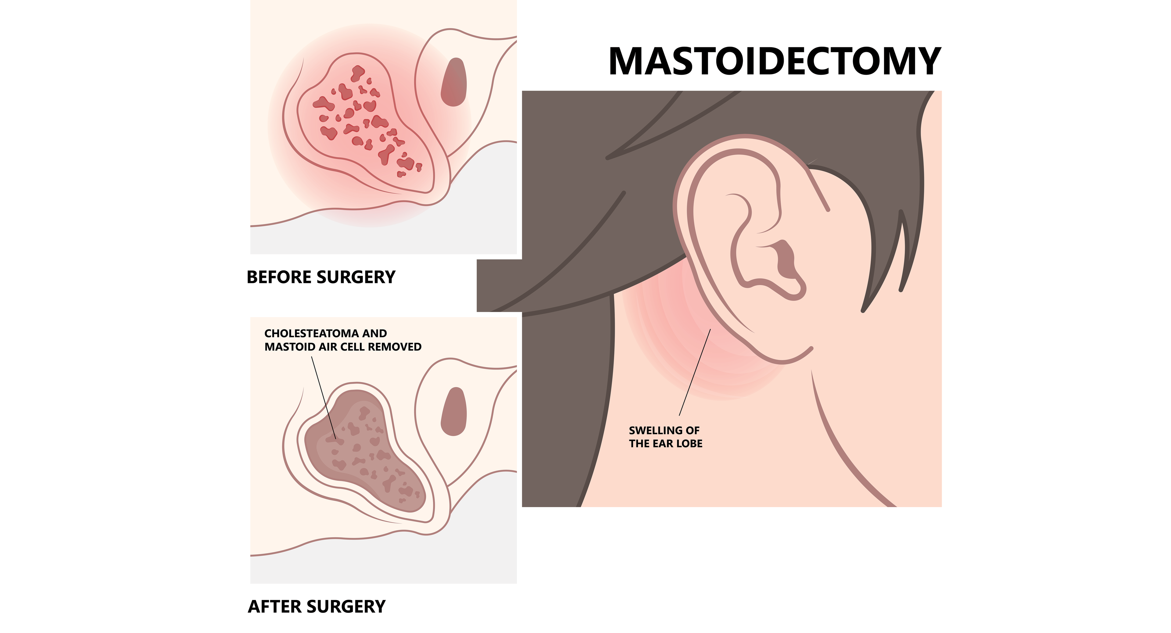 Why is Mastoidectomy performed?