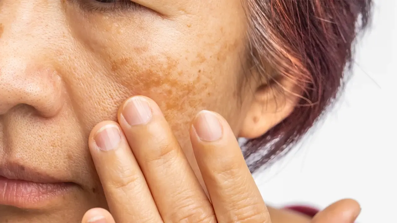 What causes melasma?