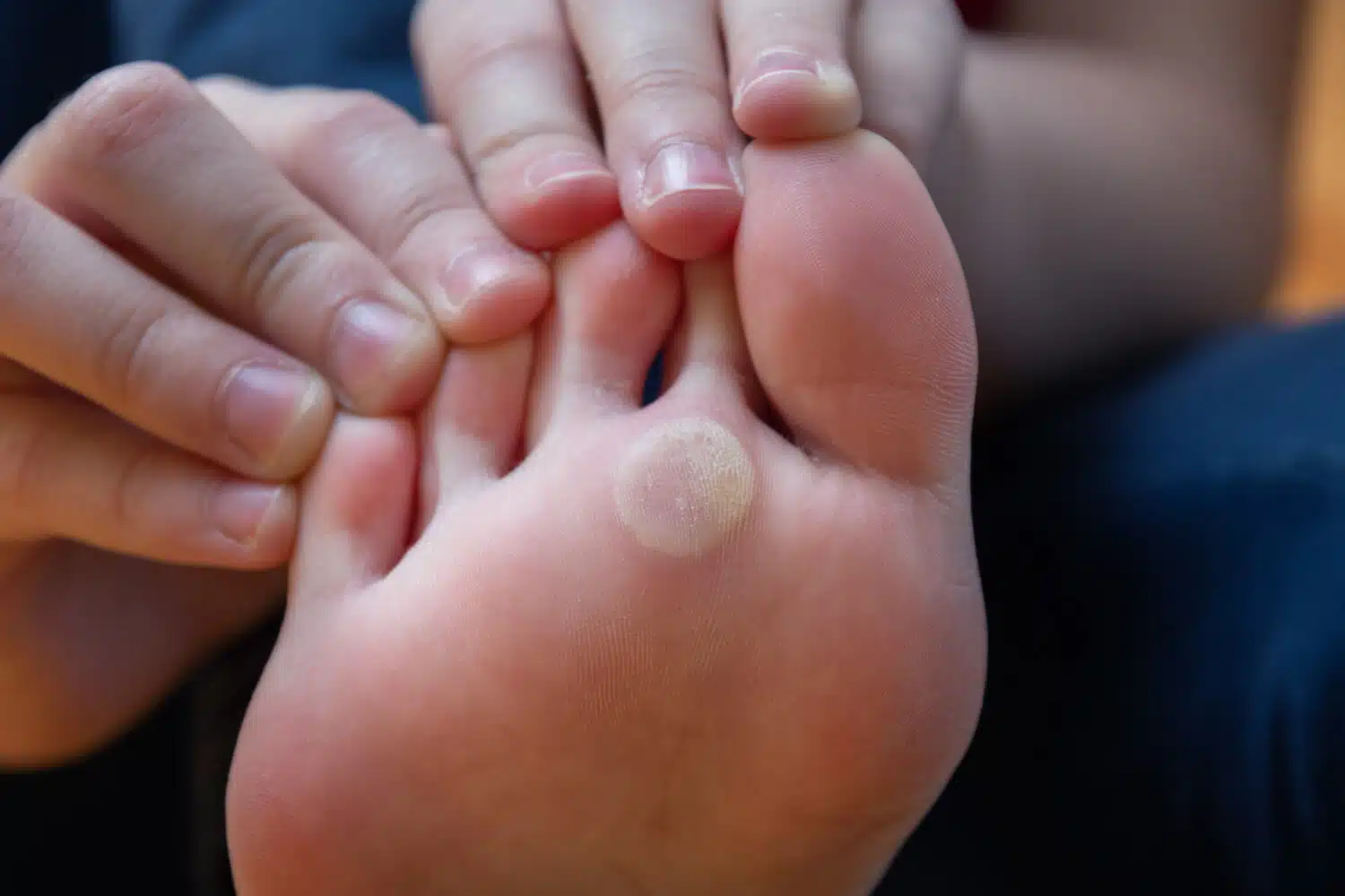 What are the types of warts?