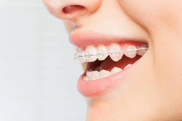 Clear aligners