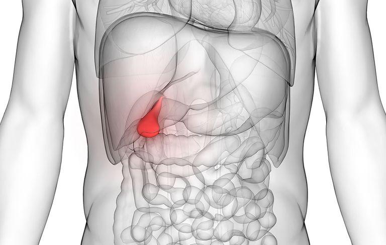 Cholecystectomy