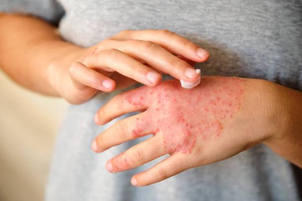 Eczema Treatment