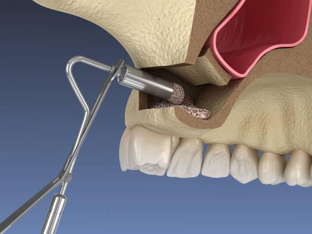 Sinus Surgery 