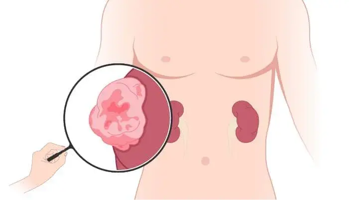 What is pyeloplasty procedure?