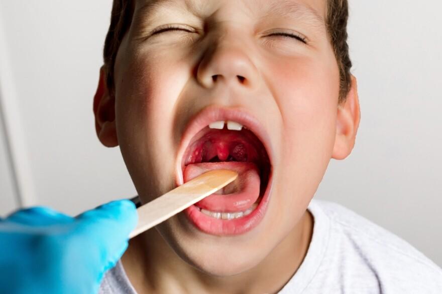 Tonsillectomy