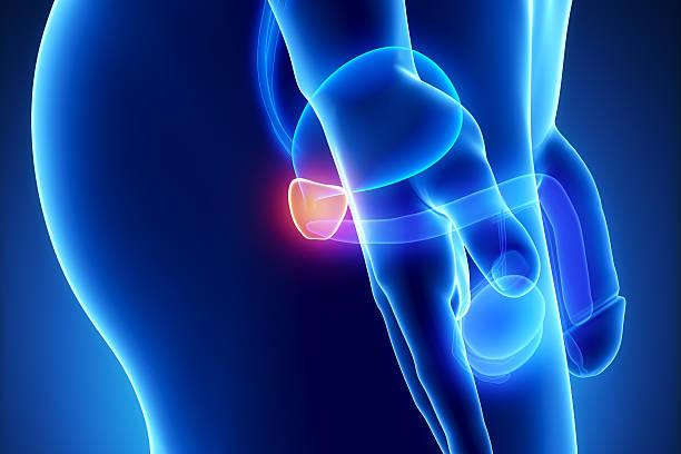 Who needs a bladder removal?