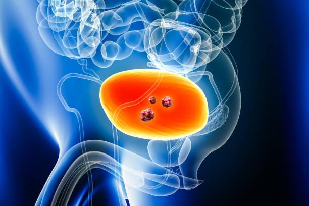 How is life after a cystectomy?