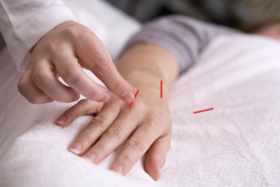 What is Acupuncture?