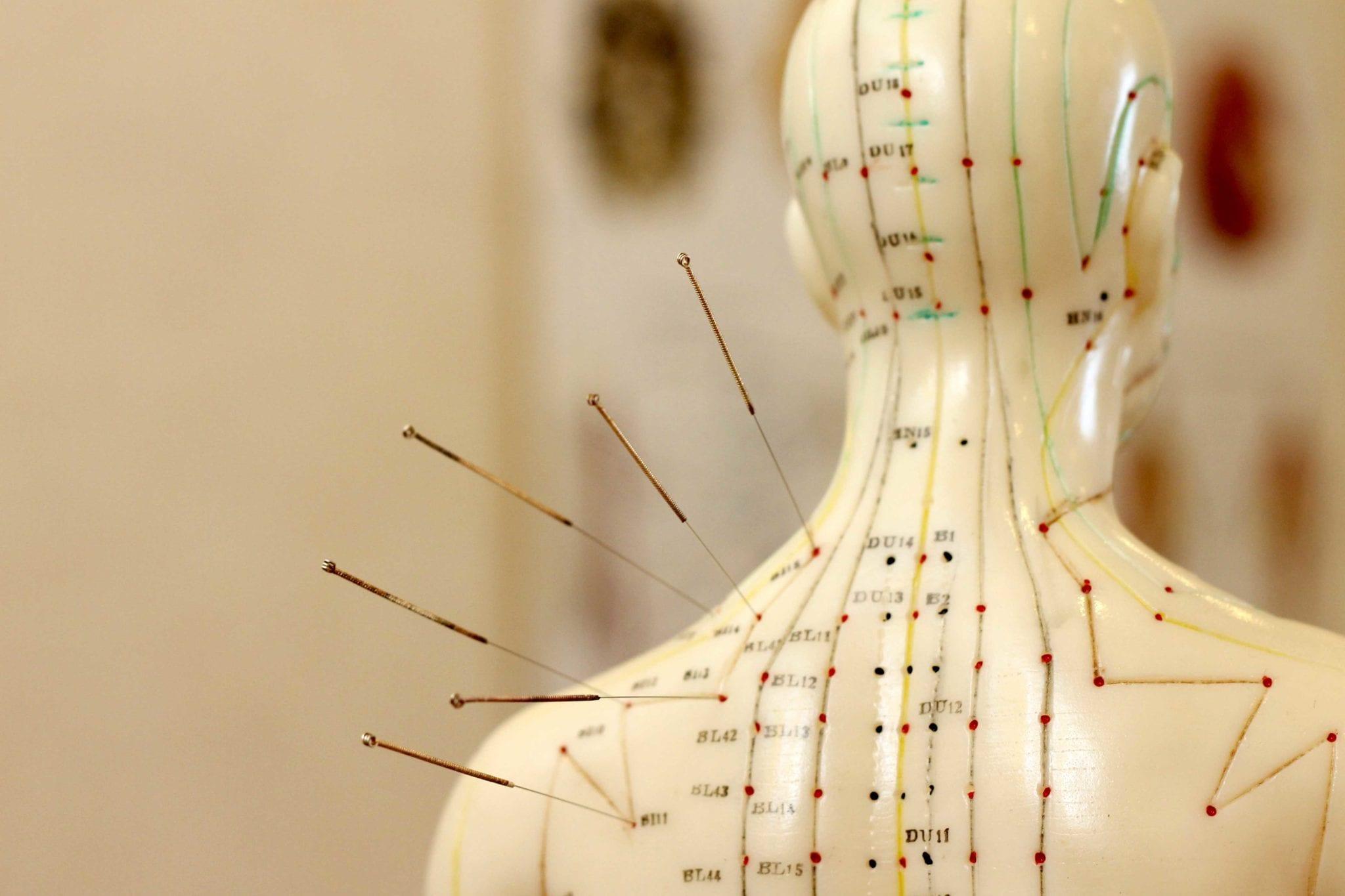 What are the benefits of Acupuncture?