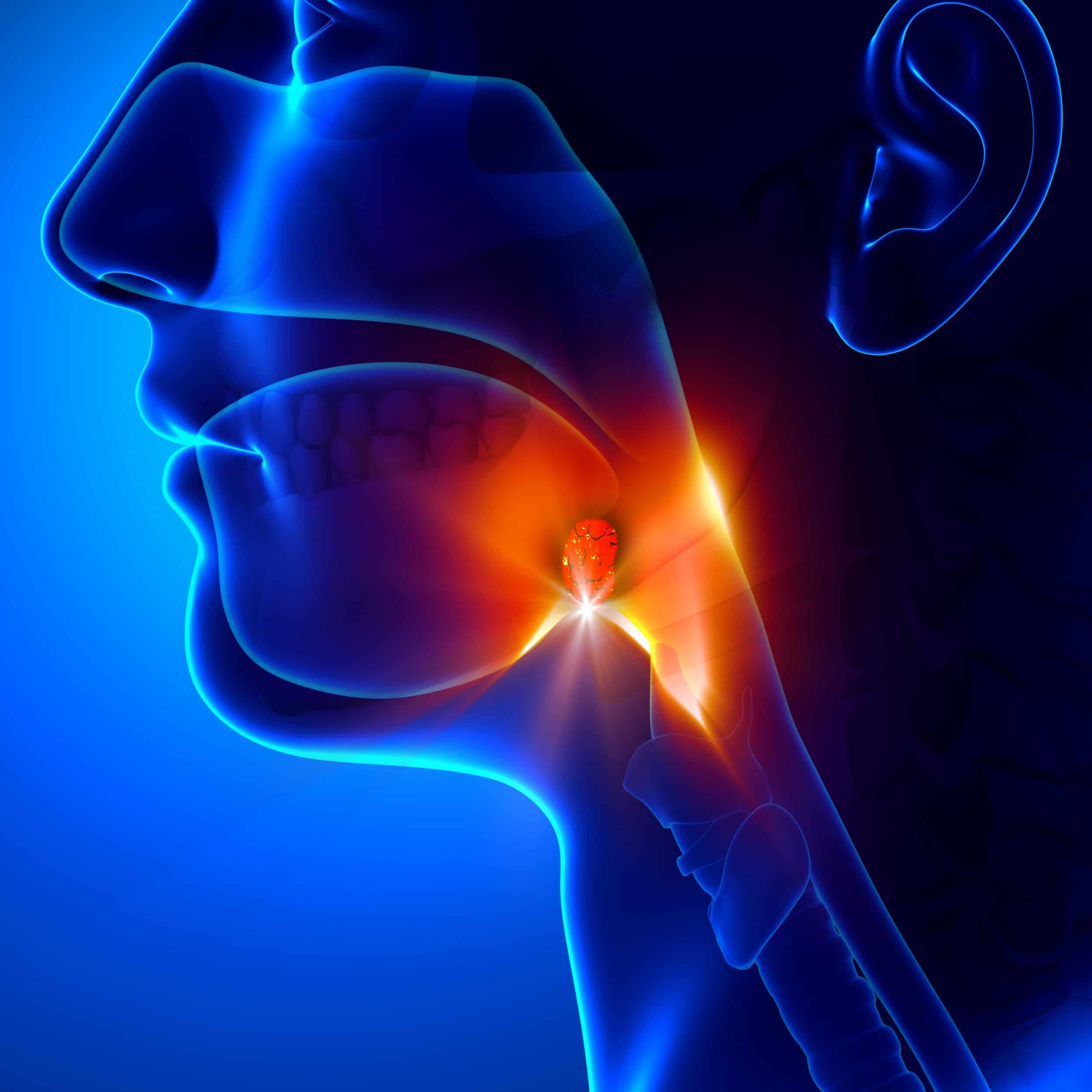 What is an adenoidectomy?