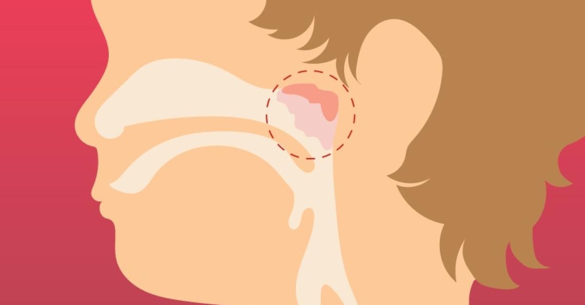 What happens during an adenoidectomy?