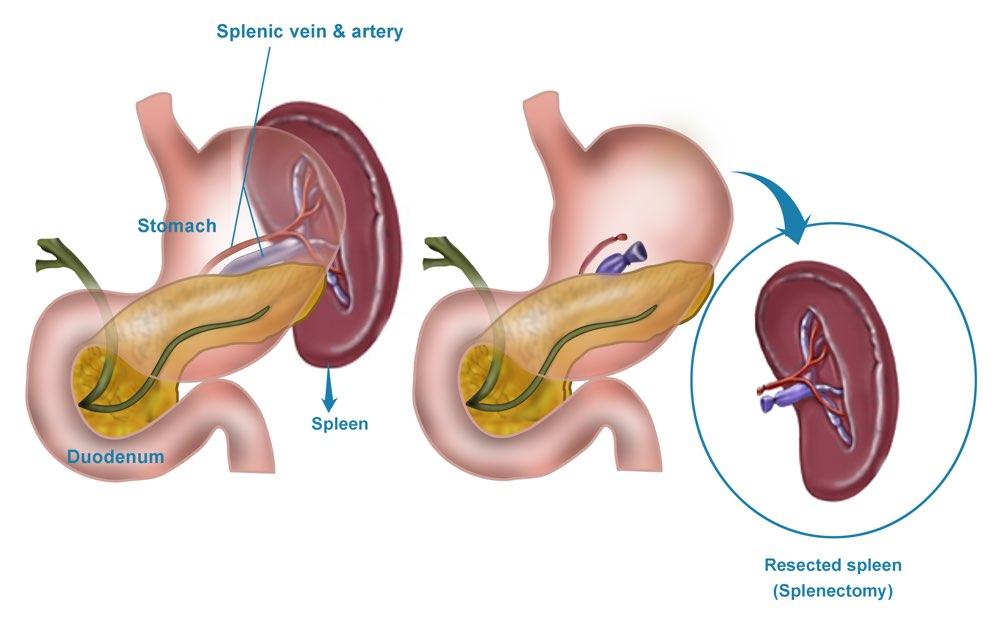 What would a Splenectomy treat?