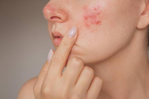 What are the types of acne?
