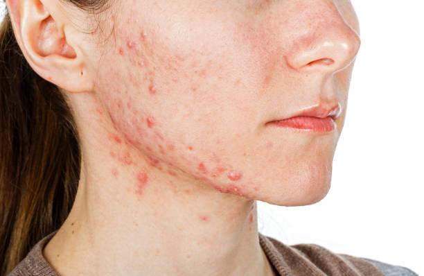 Which parts of the body does acne affect?