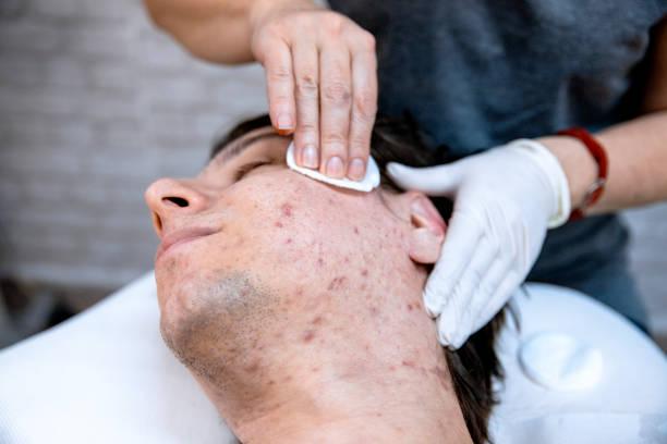Can acne be prevented?