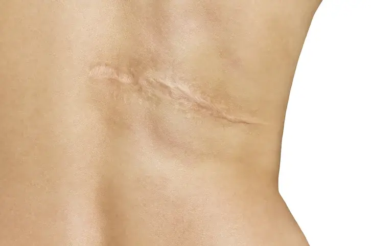 What Are the Best Options for Scar Removal?