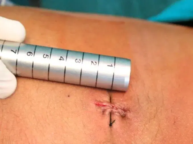 Minimally Invasive Lumbar Discectomy
