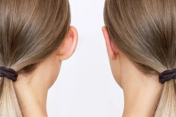 Who needs an Otoplasty?