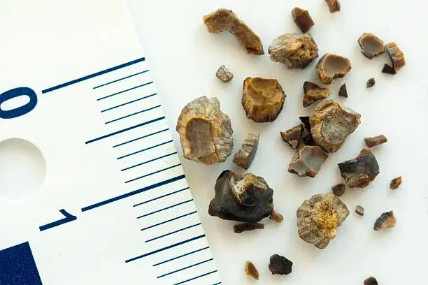 What is Lithotripsy treatment?