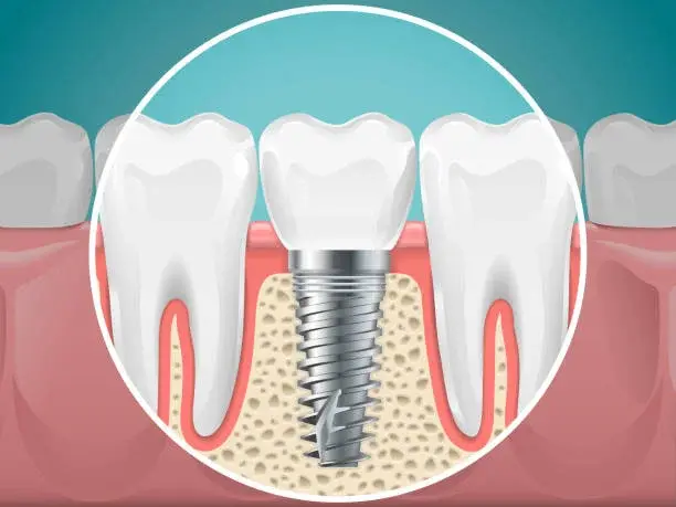 Dental Implant vs. Natural Teeth