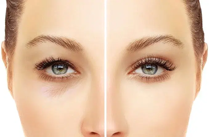 Role of Upper-Blepharoplasty in Facial Rejuvenation
