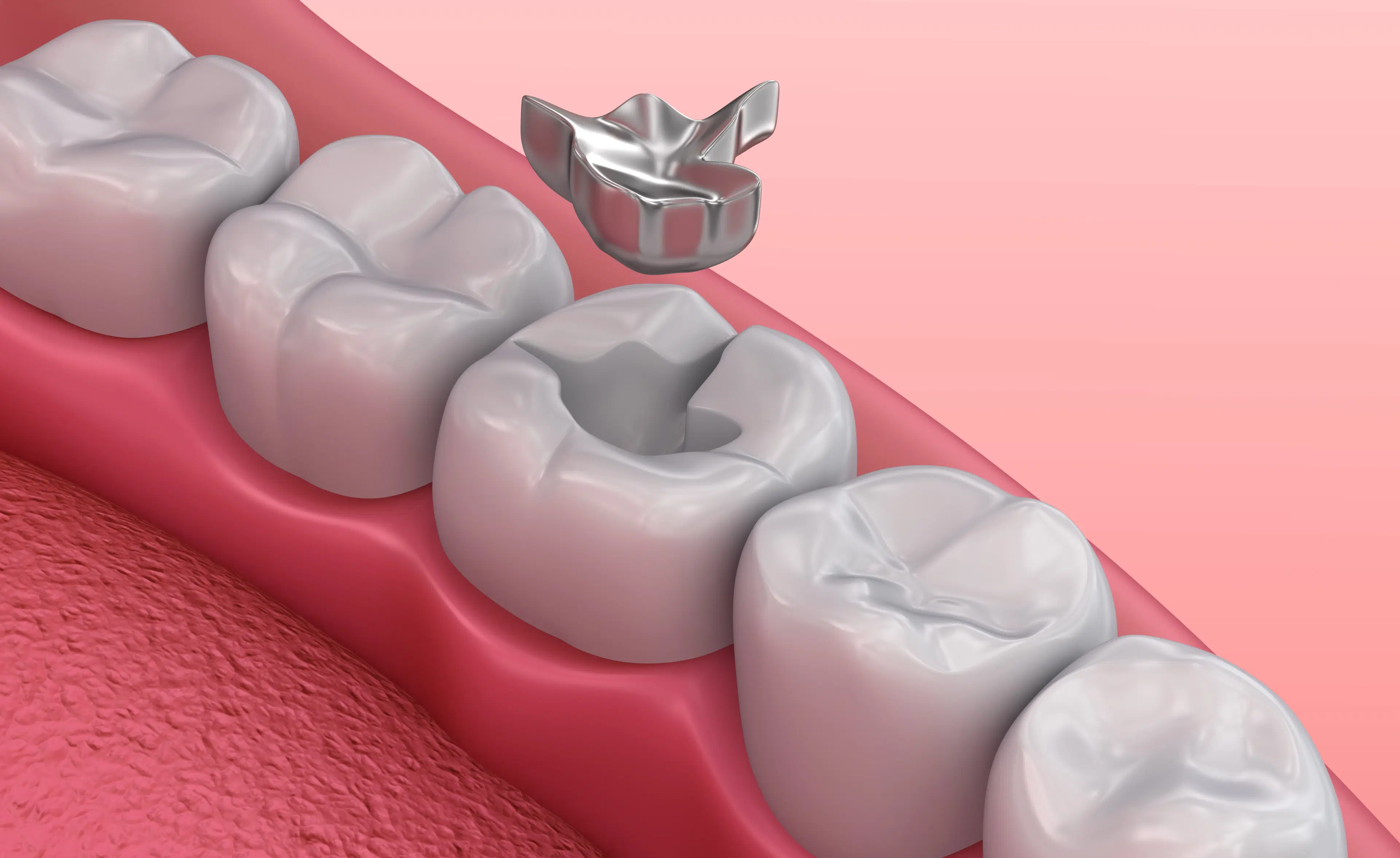 How much does a dental filling cost in Iran? 