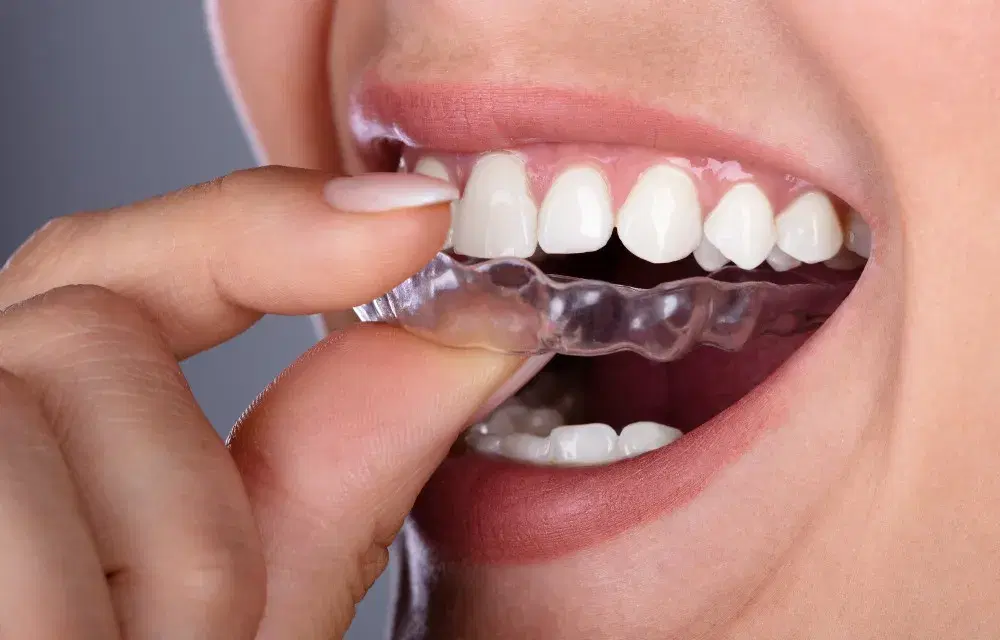 Orthodontics cost in Iran