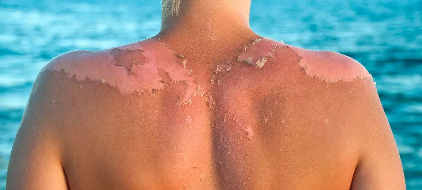 What is Skin Cancer? 